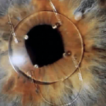 Iris clip lens implant