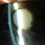 Hypermature cataract